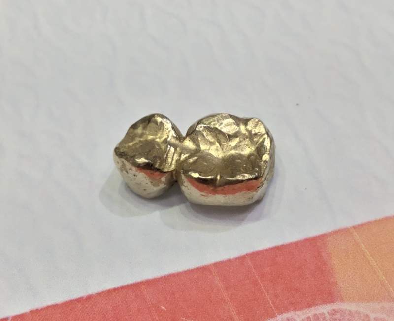 金歯 買取